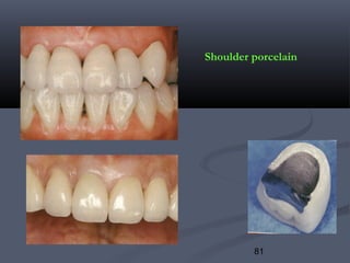 81
Shoulder porcelain
 