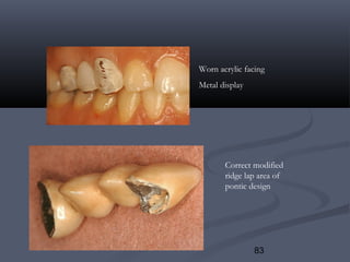 83
Worn acrylic facing
Metal display
Correct modified
ridge lap area of
pontic design
 
