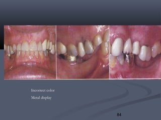 84
Incorrect color
Metal display
 