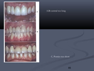 85
A.Rt central too long
C. Pontics too short
 