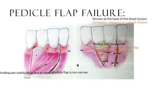 Pedicle Flaps Example Failures of periodontal therapy .pptx
