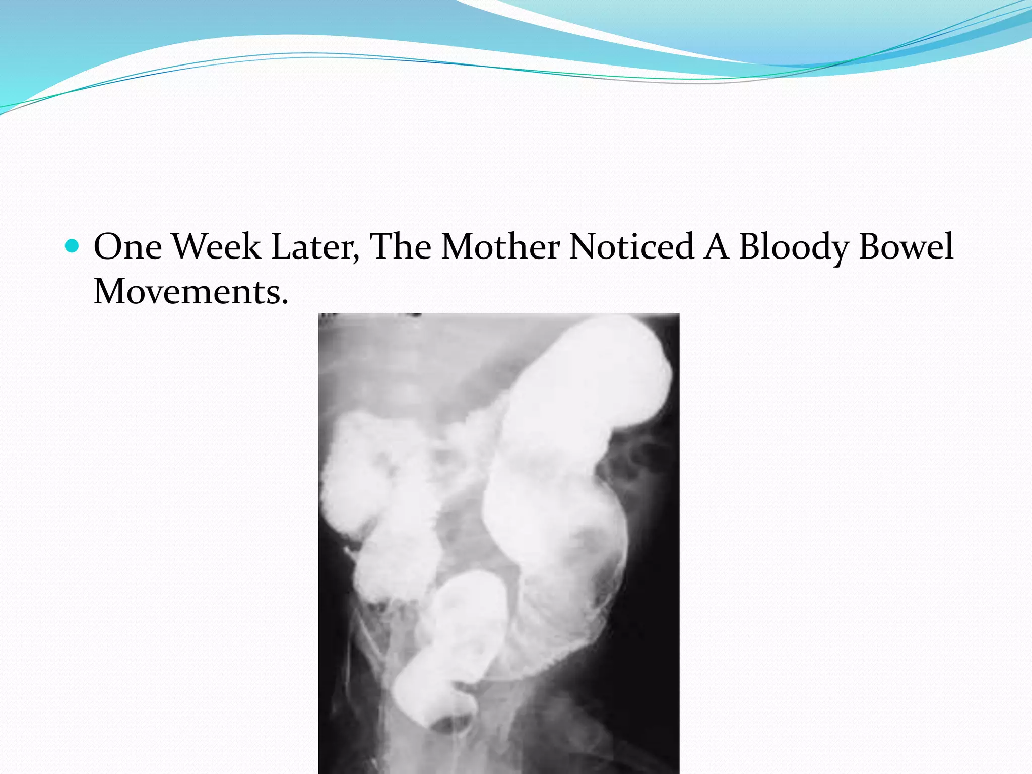  One Week Later, The Mother Noticed A Bloody Bowel
Movements.
 