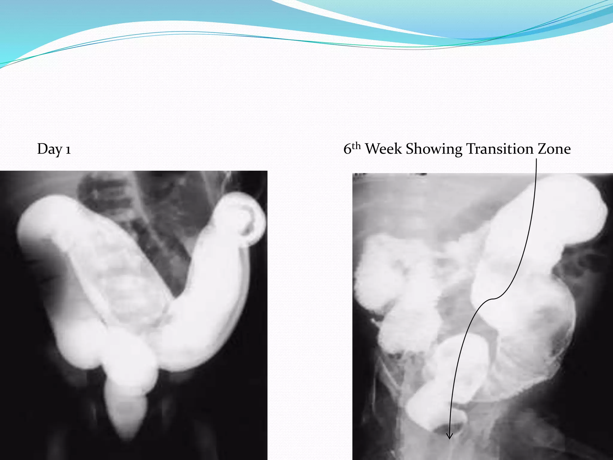 Day 1 6th Week Showing Transition Zone
 