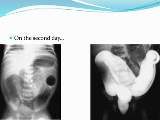  On the second day…
 