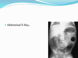  Abdominal X-Ray…
 