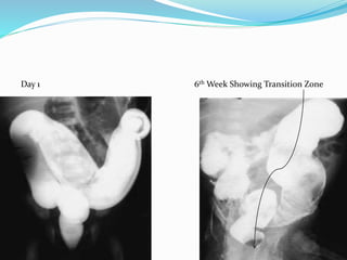 Day 1 6th Week Showing Transition Zone
 