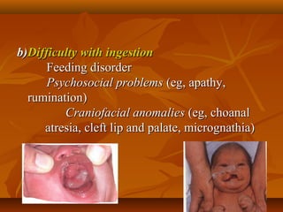 b)b)Difficulty with ingestionDifficulty with ingestion
Feeding disorderFeeding disorder
Psychosocial problemsPsychosocial problems (eg, apathy,(eg, apathy,
rumination)rumination)
Craniofacial anomaliesCraniofacial anomalies (eg, choanal(eg, choanal
atresia, cleft lip and palate, micrognathia)atresia, cleft lip and palate, micrognathia)
 
