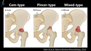 Cam-type Pincer-type Mixed-type
Khan M et al. Nature Reviews Rheumatology. 2016
 