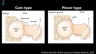 Stafford and Witt. British Journal of Hospital Medicine, 2009
Cam-type Pincer-type
 