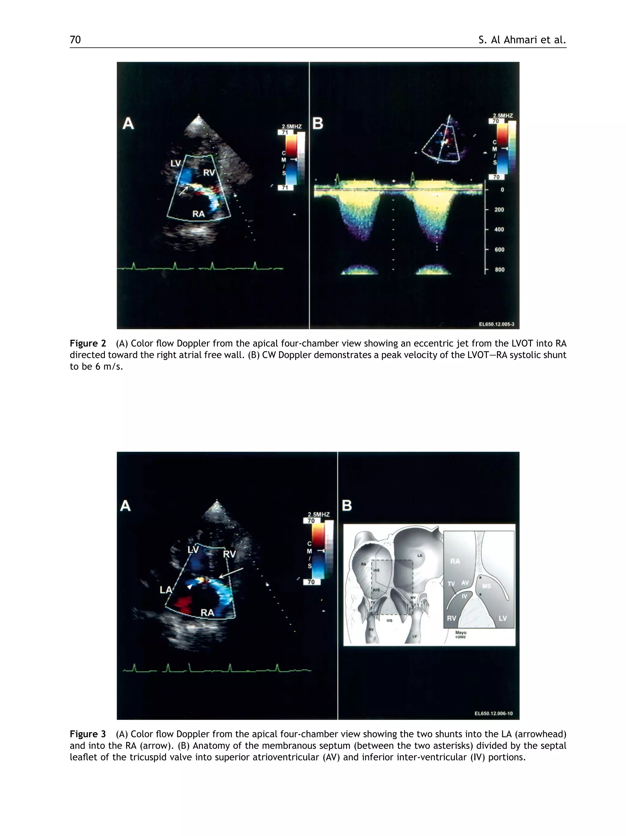 Figure 2 (A) Color ﬂow Doppler from the apical four-chamber view showing an eccentric jet from the LVOT into RA
directed toward the right atrial free wall. (B) CW Doppler demonstrates a peak velocity of the LVOTeRA systolic shunt
to be 6 m/s.
Figure 3 (A) Color ﬂow Doppler from the apical four-chamber view showing the two shunts into the LA (arrowhead)
and into the RA (arrow). (B) Anatomy of the membranous septum (between the two asterisks) divided by the septal
leaﬂet of the tricuspid valve into superior atrioventricular (AV) and inferior inter-ventricular (IV) portions.
70 S. Al Ahmari et al.
 