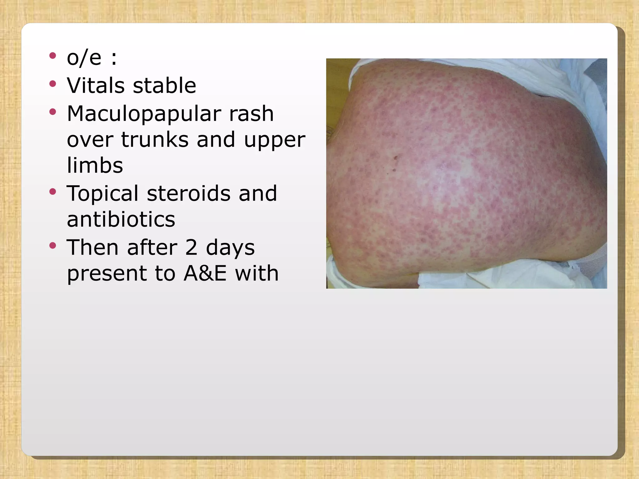 o/e : Vitals stable Maculopapular rash over trunks and upper limbs Topical steroids and antibiotics Then after 2 days present to A&E with  