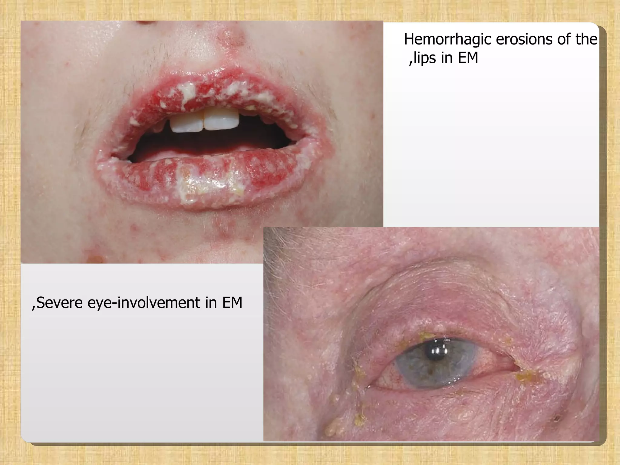 Hemorrhagic erosions of the lips in EM,  Severe eye-involvement in EM,  