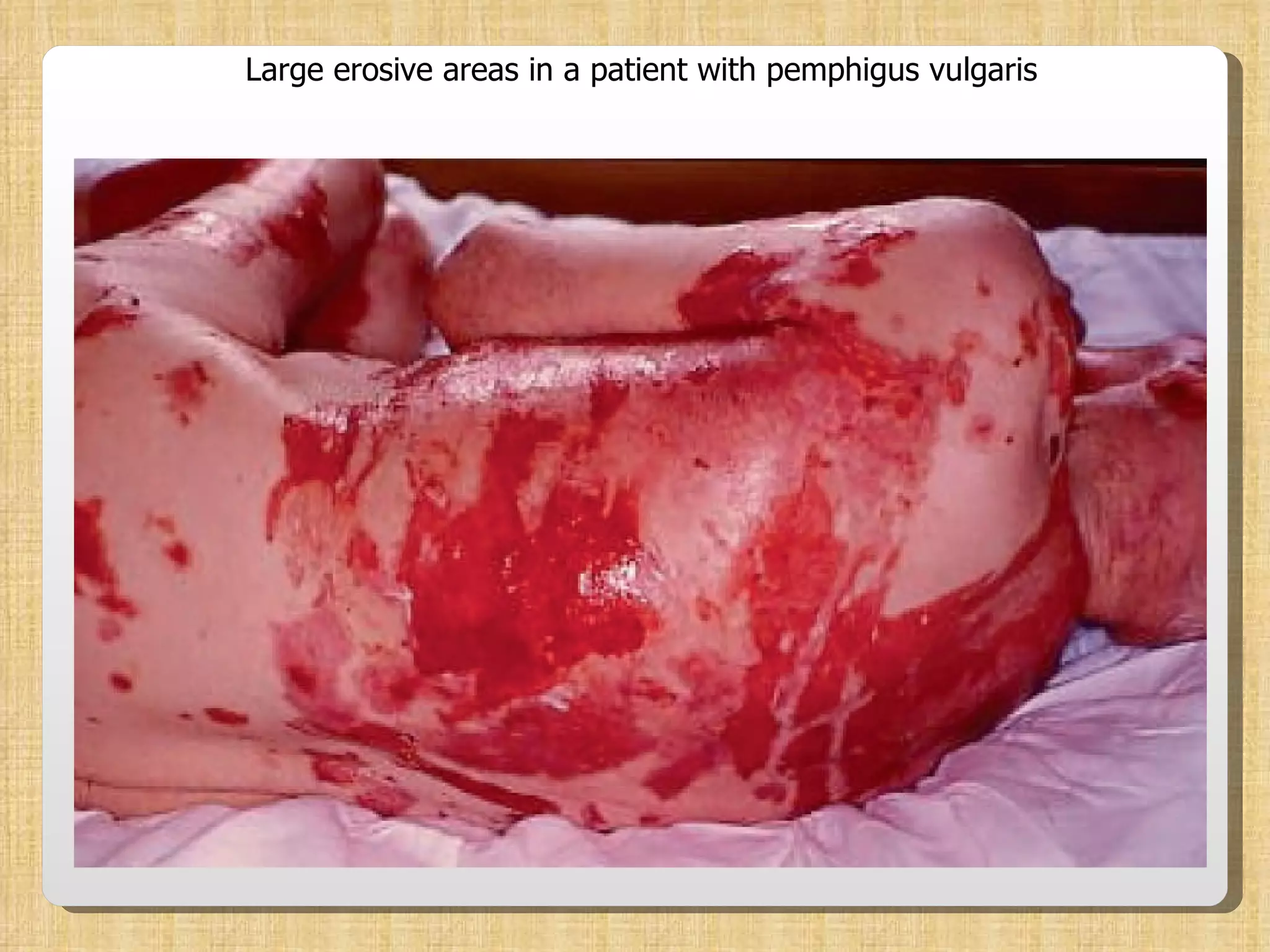 Large erosive areas in a patient with pemphigus vulgaris 