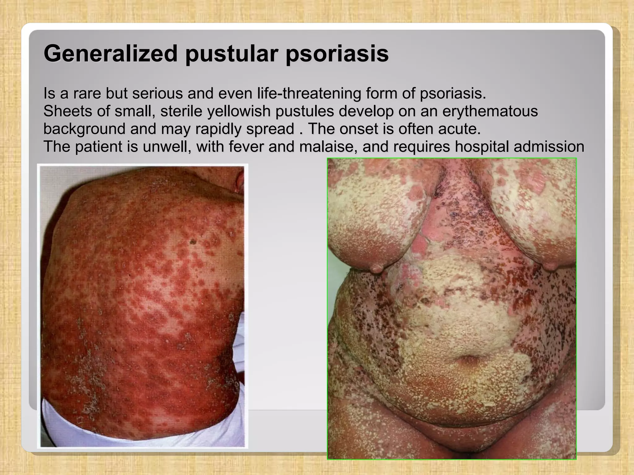 Generalized pustular psoriasis Is a rare but serious and even life-threatening form of psoriasis.  Sheets of small, sterile yellowish pustules develop on an erythematous background and may rapidly spread . The onset is often acute.  The patient is unwell, with fever and malaise, and requires hospital admission   