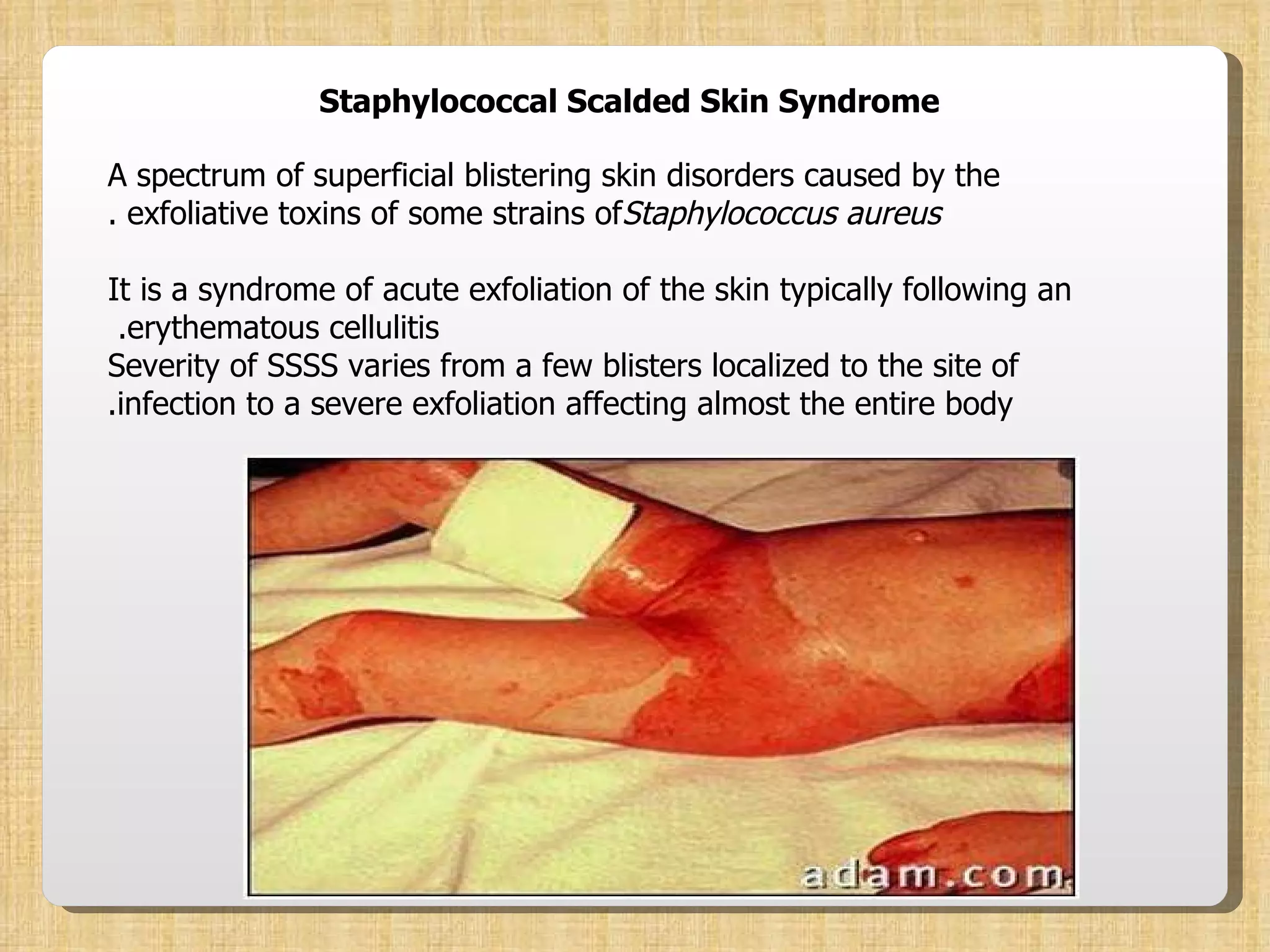 Staphylococcal Scalded Skin Syndrome A spectrum of superficial blistering skin disorders caused by the exfoliative toxins of some strains of  Staphylococcus aureus . It is a syndrome of acute exfoliation of the skin typically following an erythematous cellulitis.  Severity of SSSS varies from a few blisters localized to the site of infection to a severe exfoliation affecting almost the entire body. 