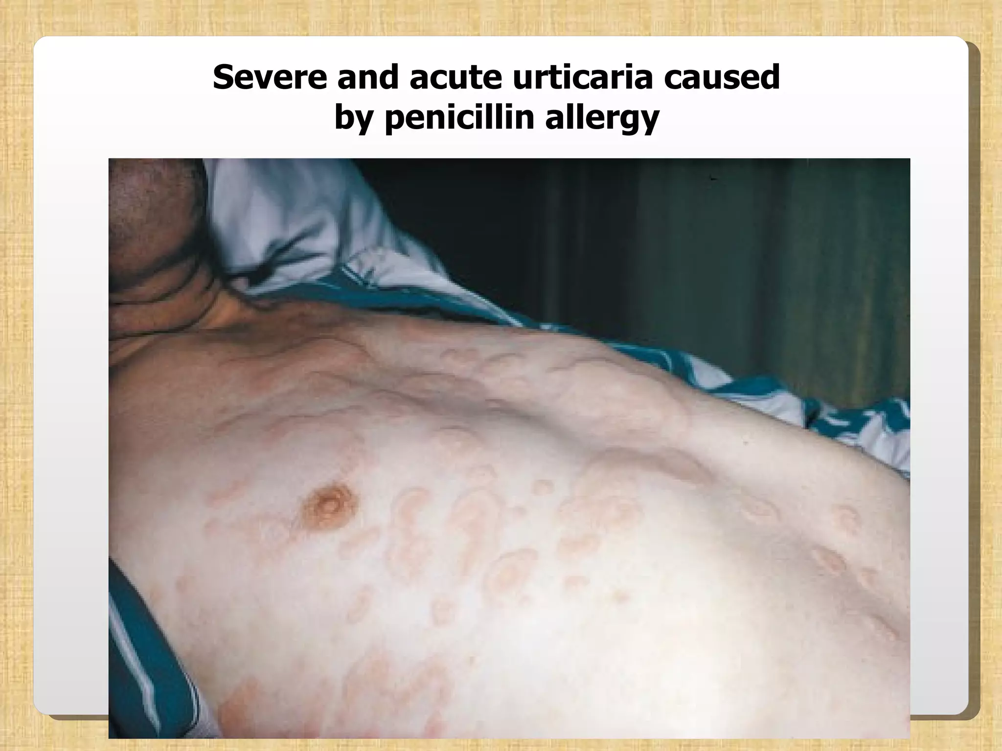 Severe and acute urticaria caused by penicillin allergy 