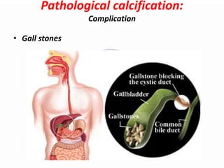 Pathologic Stones Fa1zanS: Disorder of exchange of Chromoprotein (endogenous pigment ...