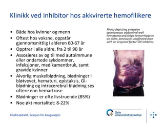 Klinikk ved inhibitor hos akkvirerte hemofilikere Både hos kvinner og menn Oftest hos voksne, oppstår gjennomsnittlig i alderen 60-67 år Opptrer i alle aldre, fra 2 til 90 år Assosieres av og til med autoimmune eller ondartede sykdommer, infeksjoner, medikamentbruk, samt gravide kvinner Alvorlig muskelblødning, blødninger i bløtvevet, hematuri, epistaksis, GI-blødning og intracerebral blødning ses oftere enn hemartrose Blødninger er ofte livstruende (85%) Noe økt mortalitet: 8-22% Photo depicting extensive spontaneous abdominal wall hematoma and thigh hemorrhage in an older, previously unaffected man with an acquired factor VIII inhibitor. Rikshospitalet, Seksjon for koagulasjon 