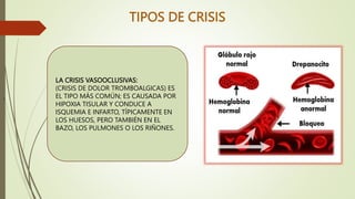 TIPOS DE CRISIS
.
LA CRISIS VASOOCLUSIVAS:
(CRISIS DE DOLOR TROMBOALGICAS) ES
EL TIPO MÁS COMÚN; ES CAUSADA POR
HIPOXIA TISULAR Y CONDUCE A
ISQUEMIA E INFARTO, TÍPICAMENTE EN
LOS HUESOS, PERO TAMBIÉN EN EL
BAZO, LOS PULMONES O LOS RIÑONES.
 