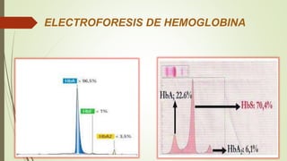 ELECTROFORESIS DE HEMOGLOBINA
 