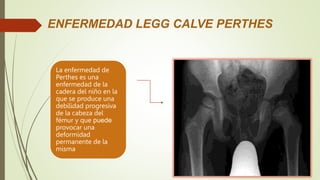 La enfermedad de
Perthes es una
enfermedad de la
cadera del niño en la
que se produce una
debilidad progresiva
de la cabeza del
fémur y que puede
provocar una
deformidad
permanente de la
misma
ENFERMEDAD LEGG CALVE PERTHES
 