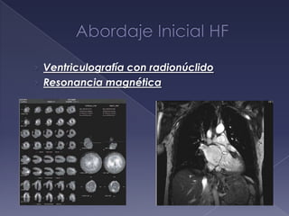 › Ventriculografía con radionúclido
› Resonancia magnética
 