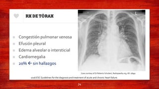 RX DE TÓRAX
■ Congestión pulmonar venosa
■ Efusión pleural
■ Edema alveolar o intersticial
■ Cardiomegalia
■ 20%  sin hallazgos
24
2016 ESC Guidelines for the diagnosis and treatment of acute and chronic heart failure.
Case courtesy of Dr Roberto Schubert, Radiopaedia.org, rID: 18991
 