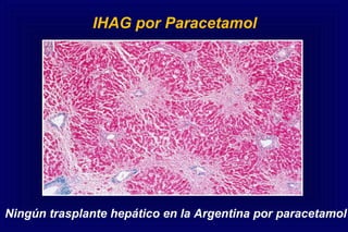 IHAG por Paracetamol
Ningún trasplante hepático en la Argentina por paracetamol
 