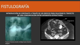 Fall Intestinal Falla intestinal | PPTX