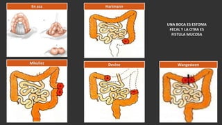 Fall Intestinal Falla intestinal | PPTX