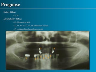 Prognose Sichere Zähne: - 33,34 „ Zweifelhafte“ Zähne: - 13, 23 massiver Stift - 32, 31, 41, 42, 43, 44, 45 Attachment Verlust - 47 vertikaler Knocheneinbruch mesial ? ? ? ? ? √ √ ? ? ? ? ? 