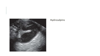 Hydrosalpinx
 