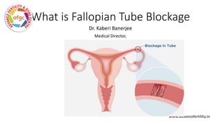 What is Fallopian Tube Blockage
Dr. Kaberi Banerjee
Medical Director,
Advance Fertility and Gynaecology Centre
Delhi and Noida
www.advancefertility.in
 