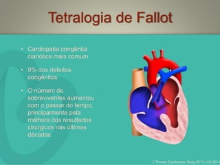 Tetralogia de Fallot
• Cardiopatia congênita
cianótica mais comum
• 9% dos defeitos
congênitos
• O número de
sobreviventes aumentou
com o passar do tempo,
principalmente pela
melhora dos resultados
cirurgicos nas últimas
décadas
J Thorac Cardiovasc Surg 2011;142:351-8
 