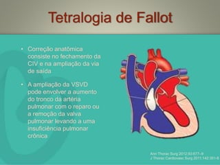 Tetralogia de Fallot
• Correção anatômica
consiste no fechamento da
CIV e na ampliação da via
de saída
• A ampliação da VSVD
pode envolver a aumento
do tronco da artéria
pulmonar com o reparo ou
a remoção da valva
pulmonar levando a uma
insuficiência pulmonar
crônica
Ann Thorac Surg 2012;93:677–9
J Thorac Cardiovasc Surg 2011;142:351-8
 
