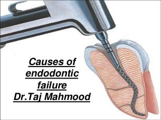 Powerpoint Templates Page 1
Causes of
endodontic
failure
Dr.Taj Mahmood
 