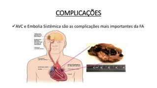 COMPLICAÇÕES
AVC e Embolia Sistêmica são as complicações mais importantes da FA
 