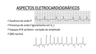 ASPECTOS ELETROCARDIOGRÁFICOS
Ausência da onda P
Presença de onda f (geralmente em V1 )
Espaços R-R variáveis- variação da amplitude
QRS normal
 