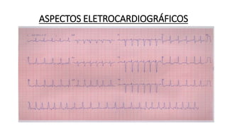 ASPECTOS ELETROCARDIOGRÁFICOS
 