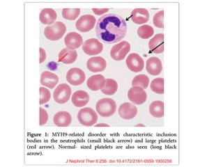 J Nephrol Ther 6:256. doi:10.4172/2161-0959.1000256
 