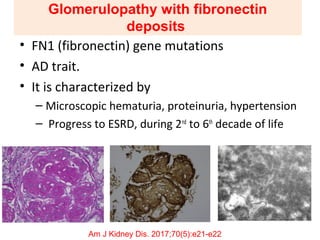 Glomerulopathy with fibronectin
deposits
• FN1 (fibronectin) gene mutations
• AD trait.
• It is characterized by
– Microscopic hematuria, proteinuria, hypertension
– Progress to ESRD, during 2nd
to 6th
decade of life
Am J Kidney Dis. 2017;70(5):e21-e22
 