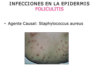 I N FECCI ON ES EN  LA EP I DERM I S 
             FOLICULITIS 


•  Agente Causal: Staphylococcus aureus 
   Agente Causal: Staphylococcus aureus
 