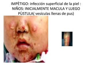 IMPÈTIGO: infección superficial de la piel : 
 NIÑOS: INICIALMENTE MACULA Y LUEGO 
    PÙSTULA( vesículas llenas de pus)
    PÙSTULA( vesículas llenas de pus) 
 
