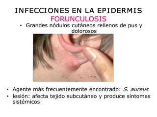 I N FECCI ON ES EN  LA EP I DERM I S 
             FORUNCULOSIS 
    •  Grandes nódulos cutáneos rellenos de pus y 
                       dolorosos 




   Agente más frecuentemente encontrado: S. aureus 
•  Agente más frecuentemente encontrado: 
•  lesión: afecta tejido subcutáneo y produce síntomas 
   lesión: afecta tejido subcutáneo y produce síntomas
   sistémicos 
 