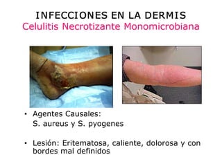 I NFECCI ON ES EN LA DERM I S 
Celulitis Necrotizante Monomicrobiana 




•  Agentes Causales: 
   S. aureus y S. pyogenes 

•  Lesión: Eritematosa, caliente, dolorosa y con 
   Lesión: Eritematosa, caliente, dolorosa y con
   bordes mal definidos 
 