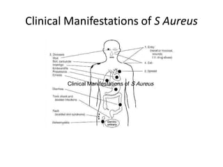 Clinical Manifestations of S Aureus 
Clinical Manifestations of 



        Clinical Manifestations of S Aureus 
        Clinical Manifestations of 
 