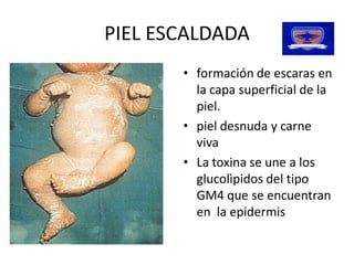 PIEL ESCALDADA 
       •  formación de escaras en 
          la capa superficial de la 
          piel. 
       •  piel desnuda y carne 
          viva 
       •  La toxina se une a los 
          glucolìpidos del tipo 
          GM4 que se encuentran 
          en  la epidermis
 