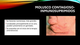 las lesiones numerosas, más grandes
Localizadas principalmente en la cara,
pueden presentarse en genitales.
Se exacerba con el inicio de la terapia
antirretroviral.
MOLUSCO CONTAGIOSO-
INMUNOSUPRIMIDOS
 