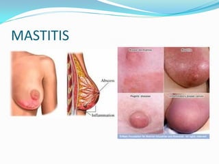 MASTITIS
 