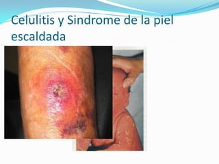 Celulitis y Sindrome de la piel
escaldada
 
